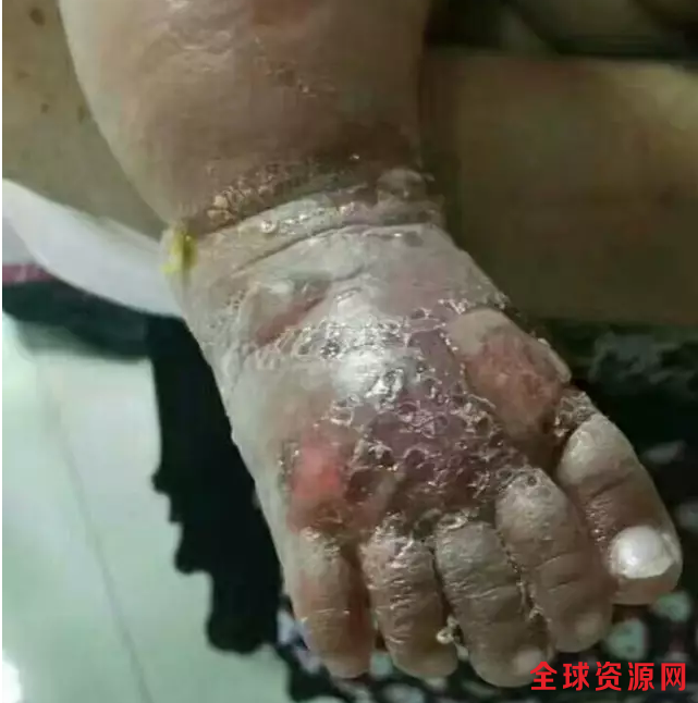 全球健康报道:青岛电视台采访到 孩子的脚上就开始红肿 起大水泡