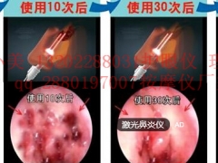 修复“黏膜毯” 治疗鼻炎激光仪厂家激光鼻炎治疗仪品牌理疗工厂图1