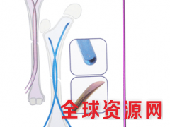 上海开为carefix弹性髓内针儿童股骨经销商图1