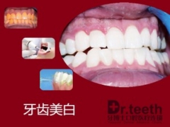 烟台牙齿美白图1