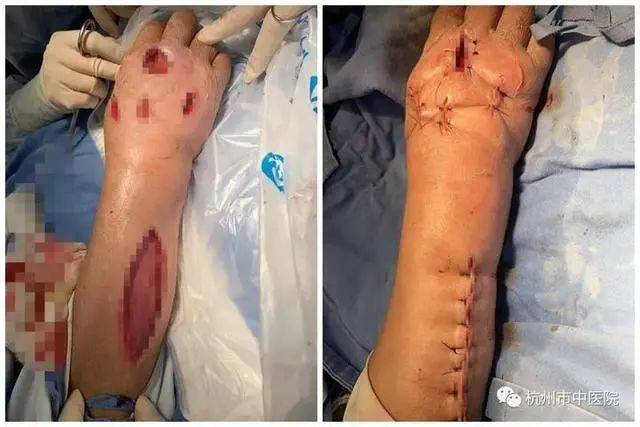 广西女子处理猪肉时被刺破手指，4天后患上罕见病，全球仅450例